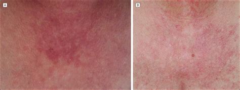 successful treatment of subacute lupus erythematosus with ustekinumab dermatology jama