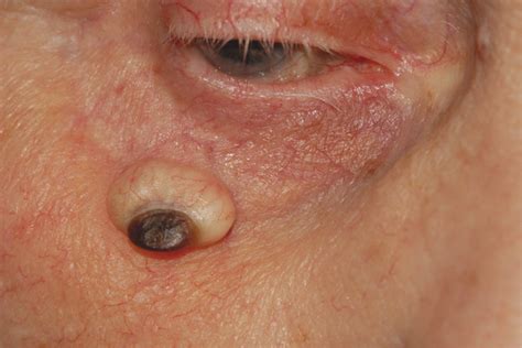 10 Eyelid And Periocular Tumors Plastic Surgery Key