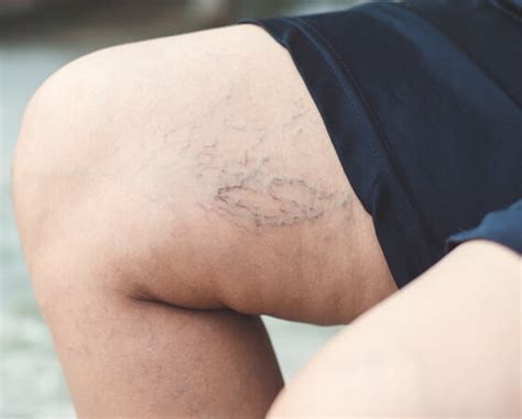 What Is The Difference Between Varicose Veins And Spider Veins Hot