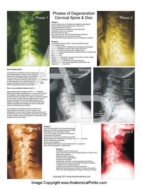 Phases Cervical Spinal Degeneration Poster 18 X 24 Chiropractic Chart
