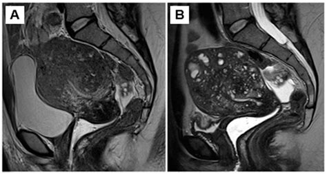 Jcm Free Full Text Conservative Management Of Uterine Adenomyosis