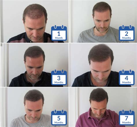 Know more about how long does it take for hair transplant grafts to regrow new hairs for the hair transplant patients. Hair Transplant Patient Timelines - Hasson & Wong