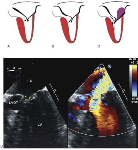 Mechanism Of Dynamic Outflow Obstruction At The Onset Of Systole A