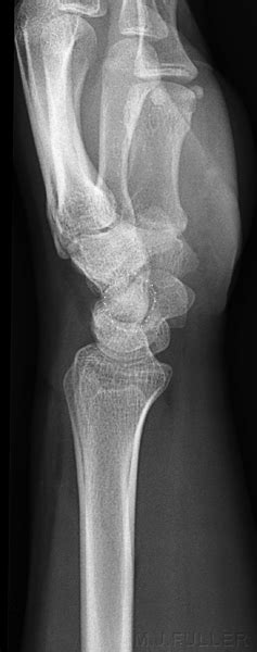 What Constitutes A True Lateral Wrist Position Wikiradiography