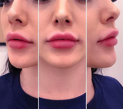 yes or no lip enhancement by me using juvederm xc ultra 1 syringe fully booke botox lips