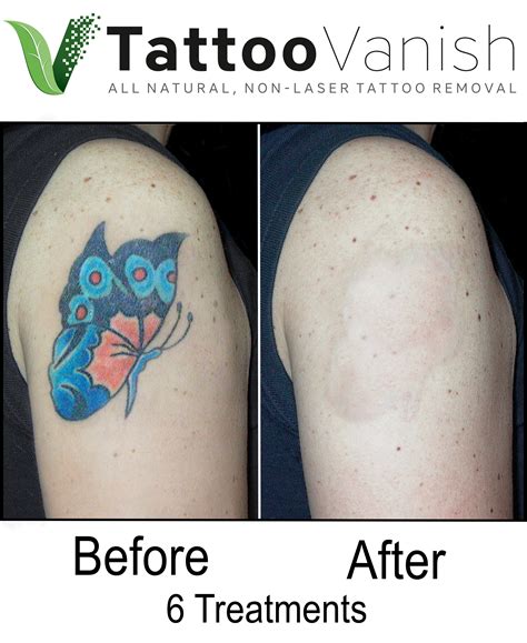 Best Tattoo Removal Tampa Tattoo Removal In Sun City West Az