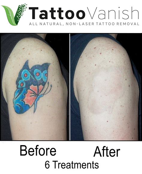 Tattoo Removal Twin Cities - All-Natural, Non-Laser Tattoo Removal