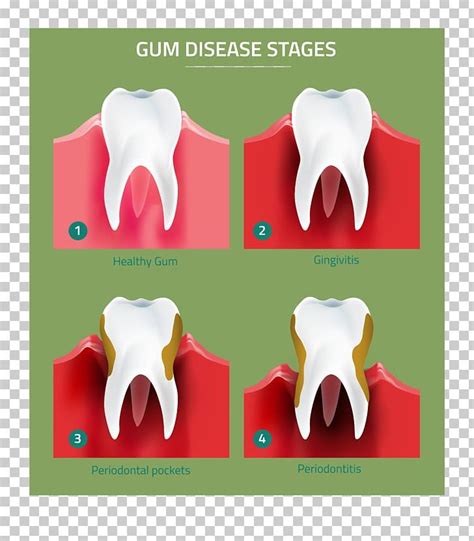 Tooth Gums Periodontal Disease Gingivitis Periodontology Png Clipart My Xxx Hot Girl