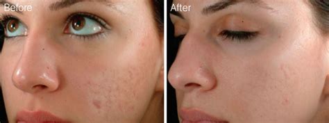 Austin Help For Acne Scarring