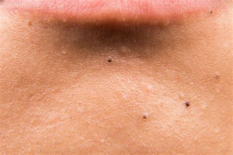 How To Reduce Black Spots On The Face Livestrong Com