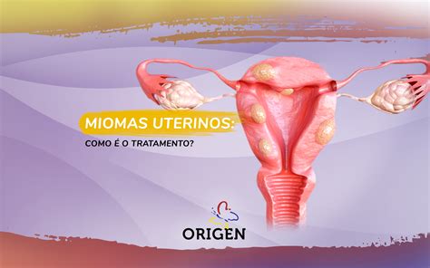 Miomas uterinos como é o tratamento Clínica Origen Fertilização