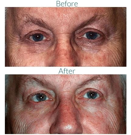 Eyelid Tumor Removal In Denver Remove Eyelid Lumps Bumps