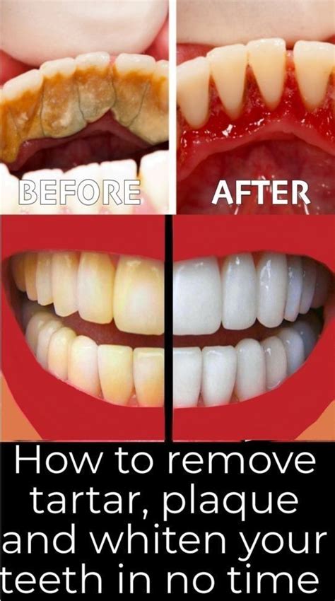 Help prevent tooth decay & future dental work. HOW TO REMOVE TARTAR, PLAQUE AND WHITEN YOUR YELLOW TEETH ...
