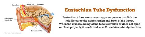 Eustachian Tube Dysfunction References