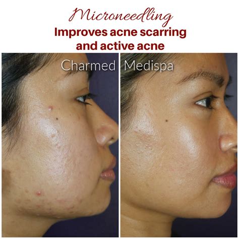 Improvement Of Acne Scarring And Active Acne With Microneedling Skinpen