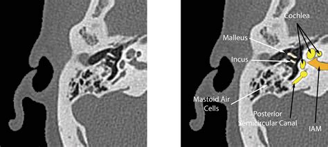 Ct Anatomy Of Ear Enteducationswansea