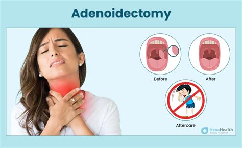Adenoidectomy Surgery Procedure Treatment And Risks
