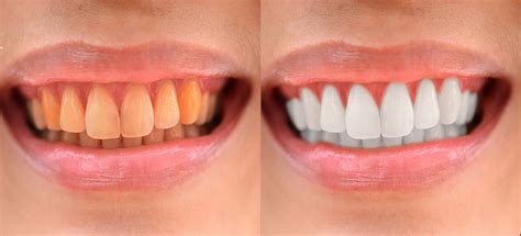 How To Whiten Teeth In Photoshop Welcome To Rephotosolution