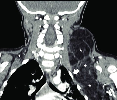 Contrast Enhanced Computed Tomography Coronal Section Of Neck And