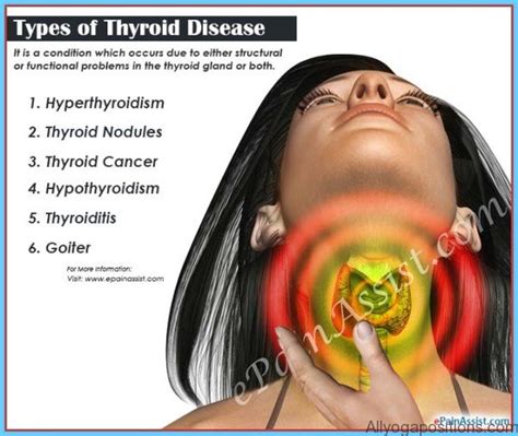 Hypothyroidism Causes Symptoms And Treatments All Yoga Positions