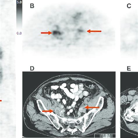 Imaging Example Of Lymph Node Metastases And Primary Tumor Site In A 82