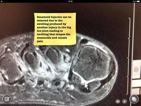 Learn about foot and ankle mri here. Foot and Ankle Problems By Dr. Richard Blake: Sesamoid Pain: Primary or Secondary to Swelling