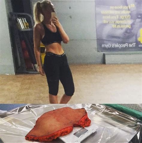 Josie Gibson Shares Graphic Surgical Photo After Having Tummy Tuck To