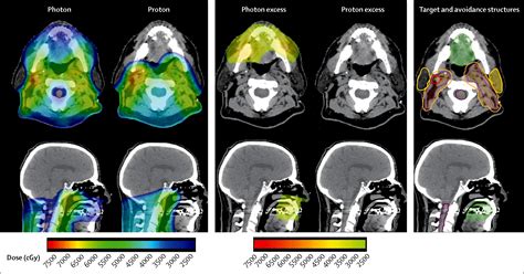 Proton Therapy For Head And Neck Cancer Expanding The Therapeutic