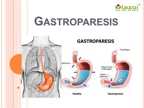 Gastroparesis Causes Symptoms Diagnosis And Treatment Ppt