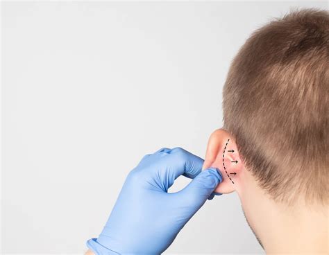 Cosmetic Ear Surgery Cygnus Clinic