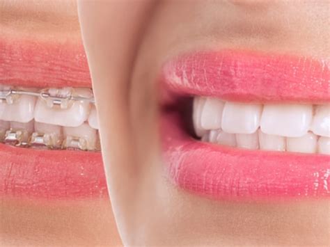 Orthodontic Treatment And Dental Braces Smartdent Clinic