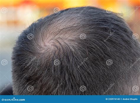 Close Up Of A Bald Spot On A Man S Head Stock Photo Image Of Growth