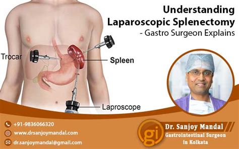 Understanding Laparoscopic Splenectomy Gastro Surgeon Explains