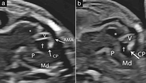 Position Of The Choroid Plexus Of The Fourth Ventricle In First‐ And