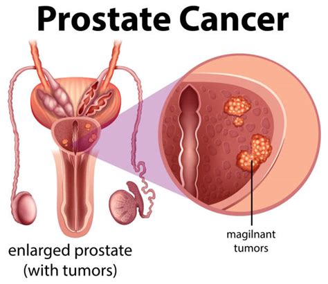 prostate gland illustrations royalty free vector graphics and clip art istock