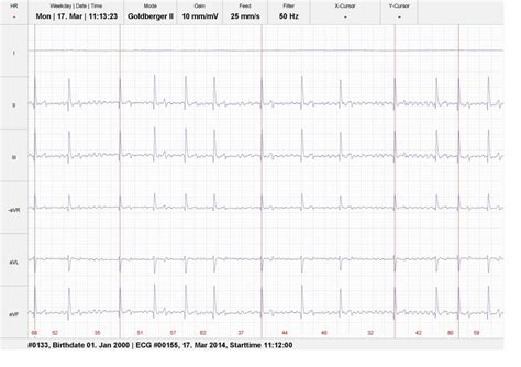 Er umfasst frequenzen ab 20 khz bis 10 ghz; Vorhofflimmern bei einem Vollbluthengst - tier-sono.de