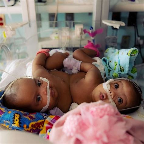 conjoined twin sisters undergo successful surgery to separate abc news