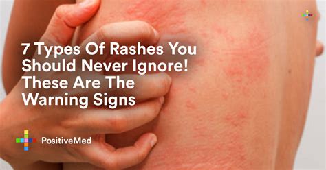 Types Of Rashes You Should Never Ignore These Are The Warning Signs D