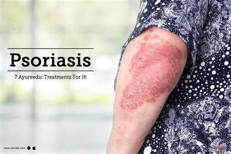 7 Best Ayurvedic Medicine For Psoriasis Treatment By Dr Sandeep