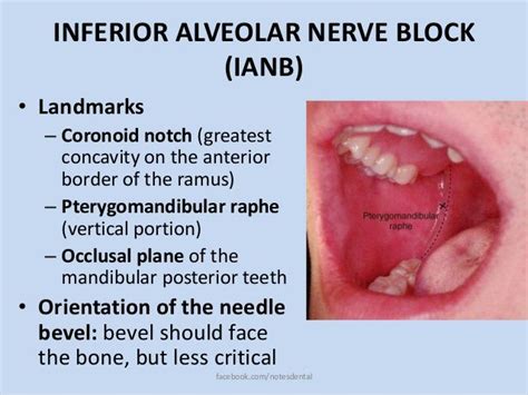 Inferior Alveolar Nerve Block Dental Hygiene School Dental