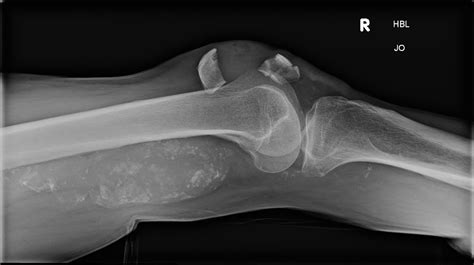 Calcification On An X Ray An Important Feature To Recognise Bmj Case