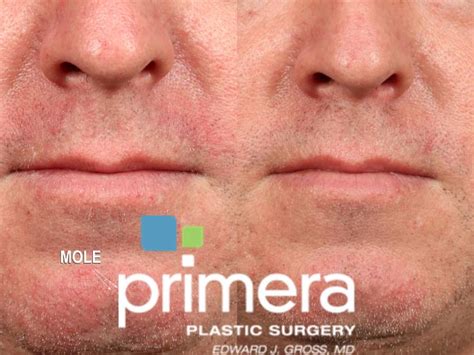 Cyst Removal Before And After Photo Gallery Orlando Florida Primera Plastic Surgery