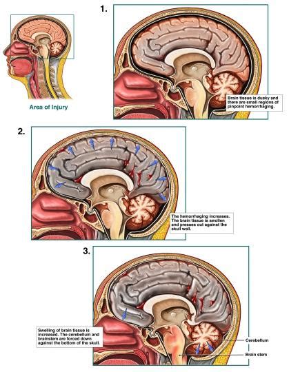 Anoxic Brain Injury Definition Risk Causes Factors Symptoms