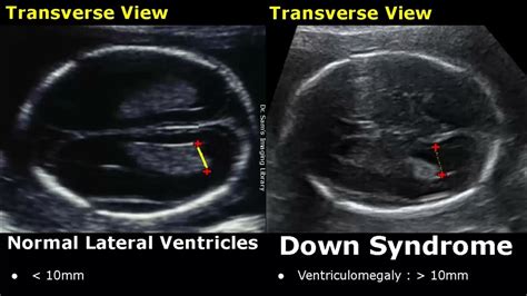Fetal Ultrasound Normal Vs Down Syndrome Soft Markers In Fetus For