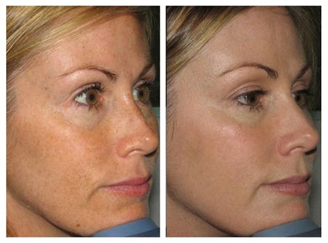 Before And After Renova Laser Hair Removal And Medspa