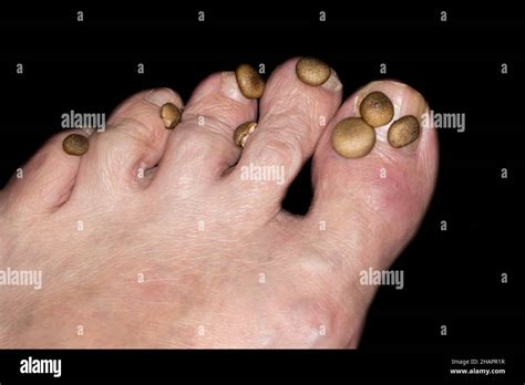 Symbolic Photo Onychomycosis Also Known As Tinea Unguium Fungal