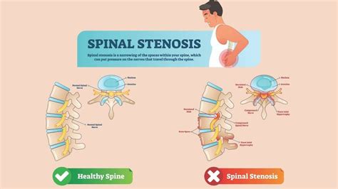 Spinal Stenosis Symptoms Diagnosis And Variations Md Nutrition