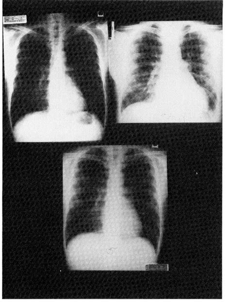 Figure 1 From Fulminant Beriberi Heart Disease With Lactic Acidosis