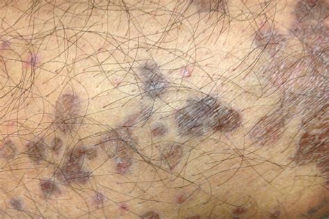 Dark Itchy Leg Lesions In A Middle Aged Man
