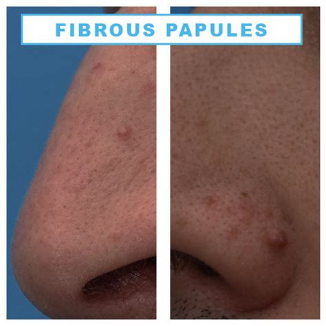 Remove Fibrous Papule Of The Nose At Home Pigtailsdrawing